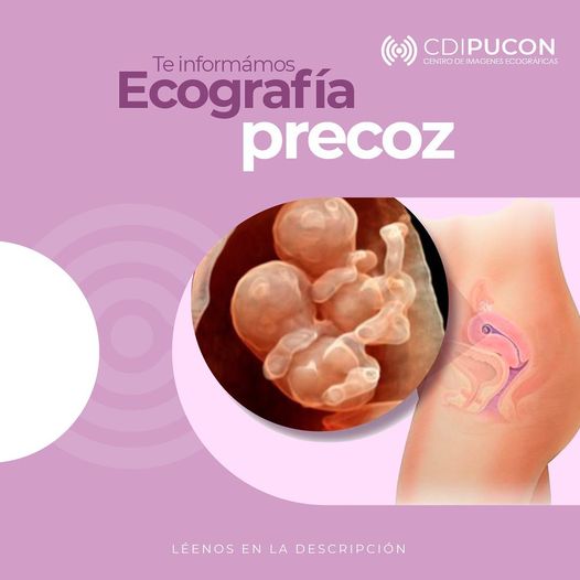 Ecografía Precoz en CDI Pucón